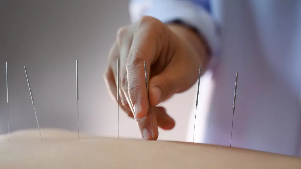 Acupuncture in Westminster | Chiroworks